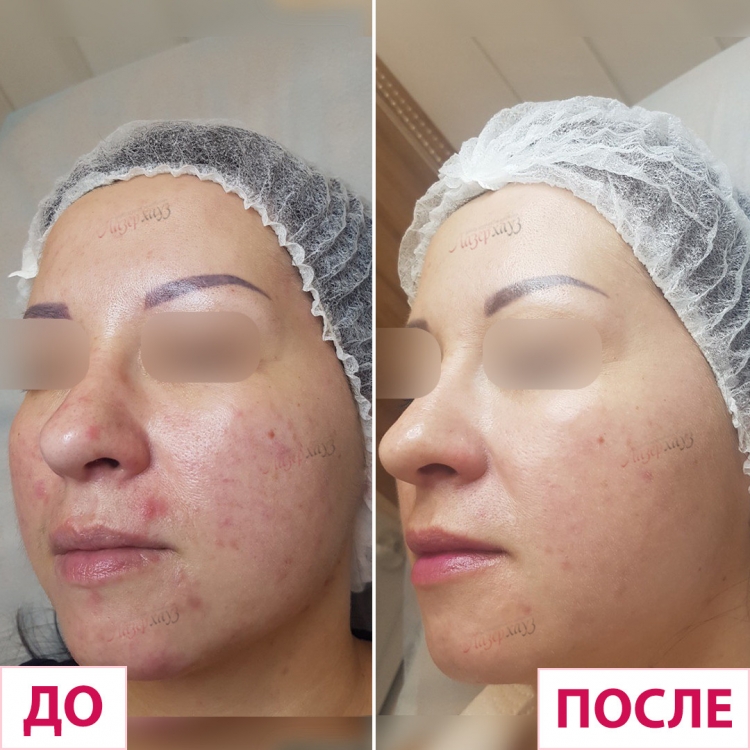 Фракционный фототермолиз лазер co2