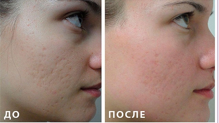 Био пилинг LUMIDERM