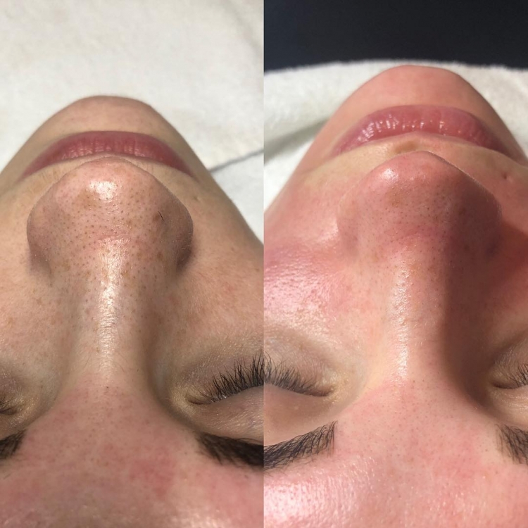 Аквапилинг HYDRAFACIAL