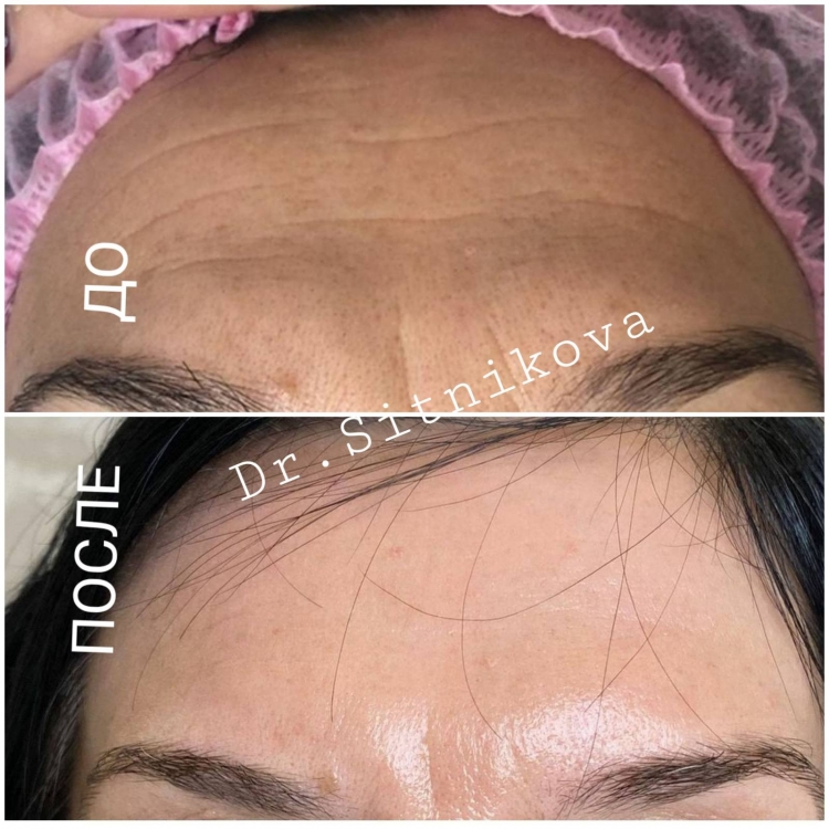 RF Lifting микро игольчитый лица