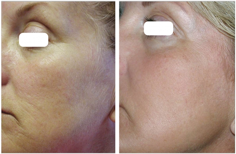 Аппарат Picosure cynosure