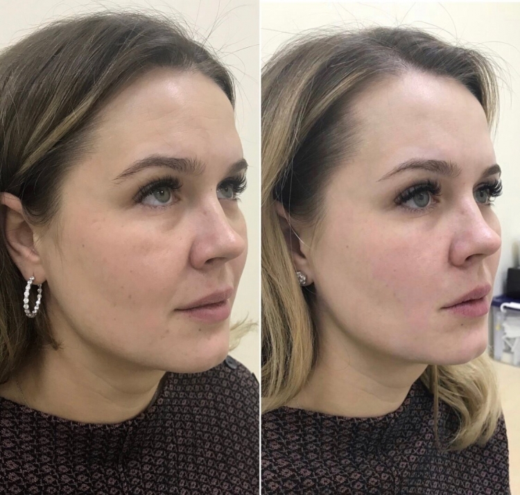 Альтера безоперационный лифтинг