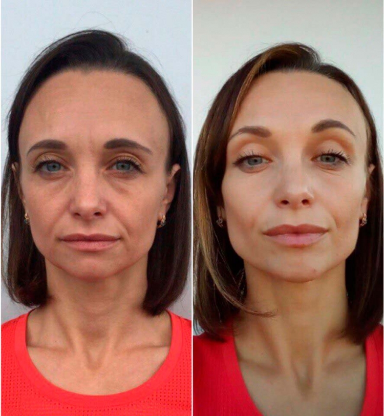 Пластический массаж лица до и после