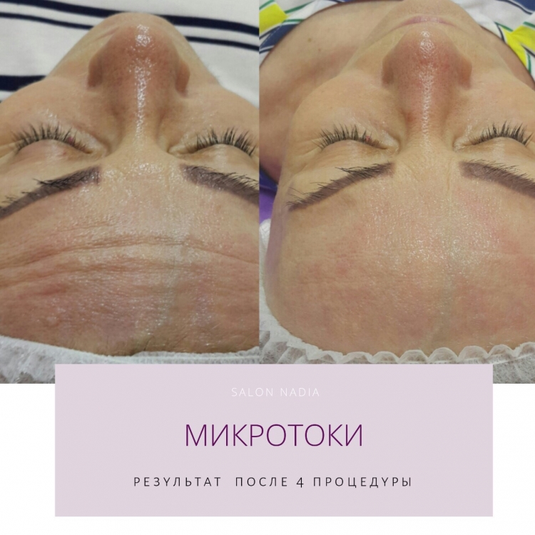 Массажные линии лица вакуумными банками